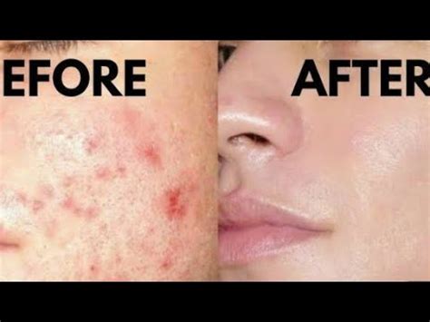 how to remove pimples in one week