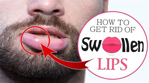 how to remove swelling from lips at home