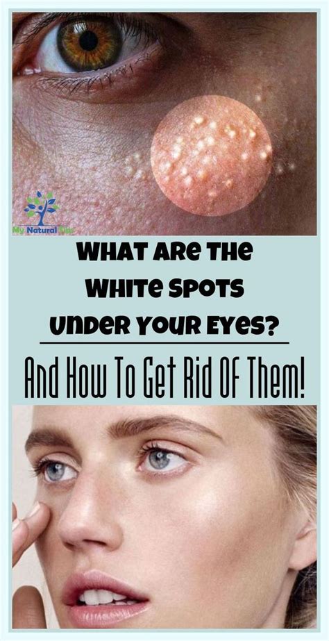 how to remove white eyes in photos