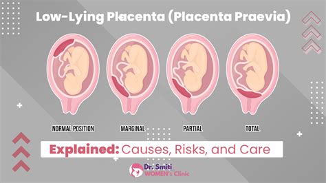 how to sleep with low lying placenta