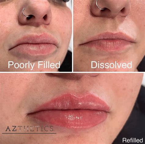 how to stop lip fillers from swelling treatment