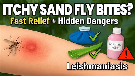 how to stop sandfly bites from itching