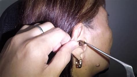 how to take out bug from ear