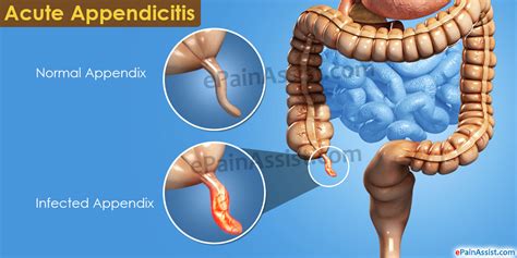 how to tell your appendix is rupturing