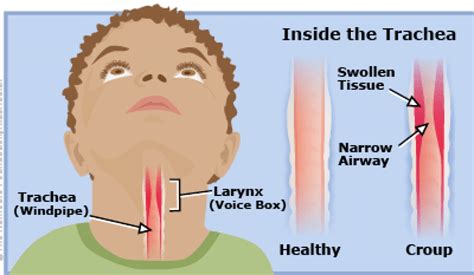 how to test kids for croup without
