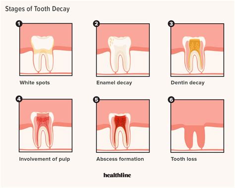 how tooth decay is treated