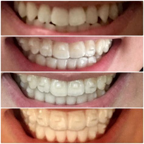 how visisble is invisaline : r/Invisalign - Reddit