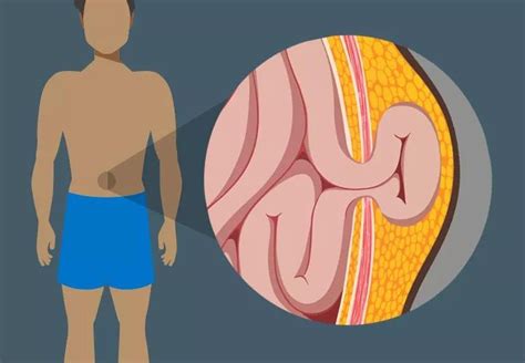 Read How To Get Rid Of Hernia Without Surgery Symptoms 