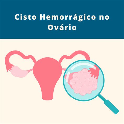 cisto hemorrágico no ovário