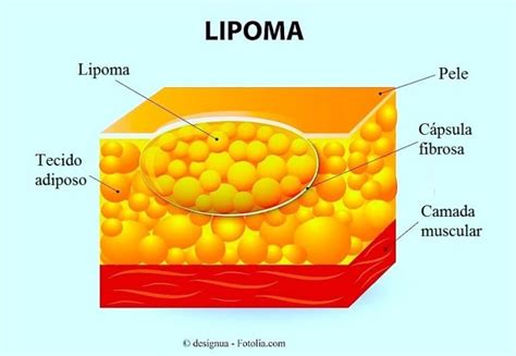 lipoma inflamado