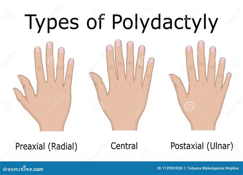 polidactilia