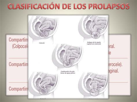 prolapso genital