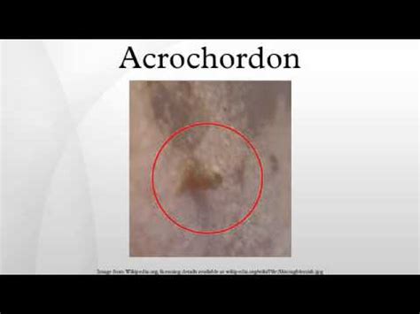 acrocordon