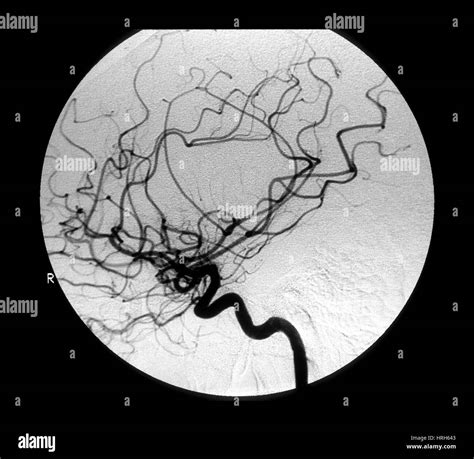 carotida