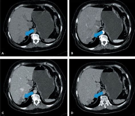 hemangioma infantil