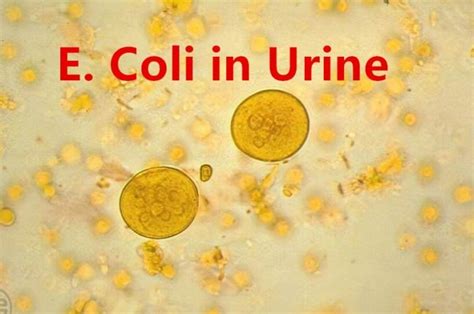 escherichia coli na urina