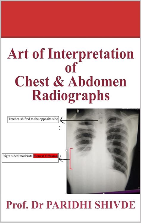 ART OF INTERPRETATION OF CHEST AND ABDOMEN RADIOGRAPHS