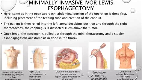 ESOFAGECTOMIA DE IVOR LEWIS