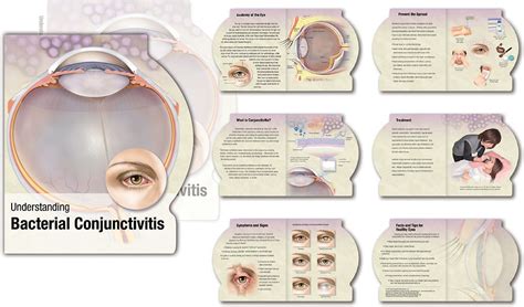 Exudative Conjunctivitis
