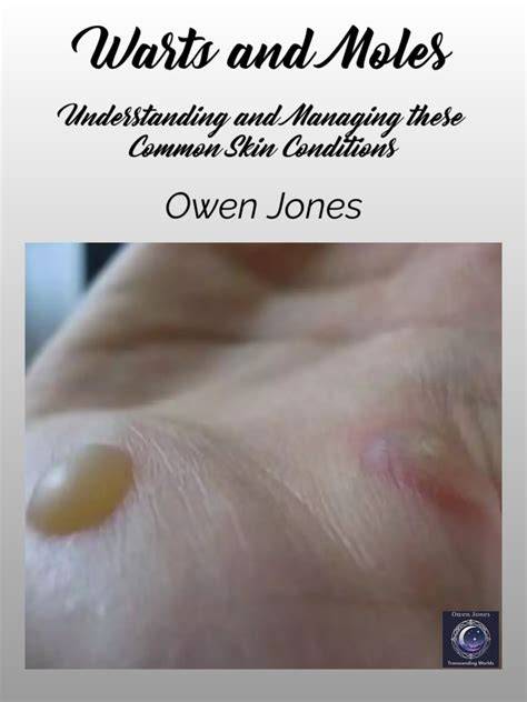 How To Cure WARTS