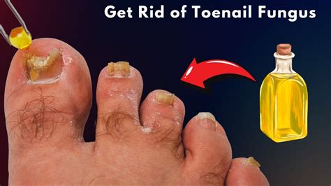 How to Get Rid of Toenail Fungus Using This Simple Guide