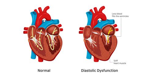 Left Ventricular Diastolic Dysfunction and Heart Failure