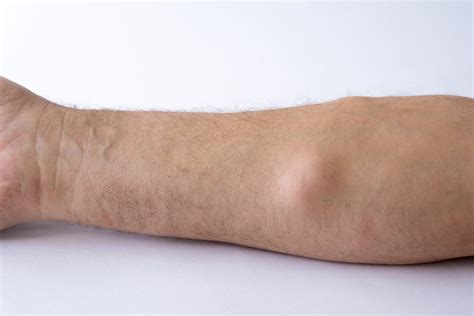 Malignant Liposarcoma