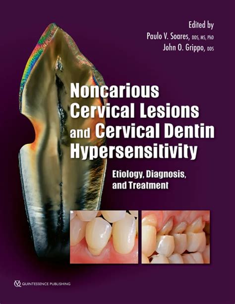 Non Carious Cervical Lesions