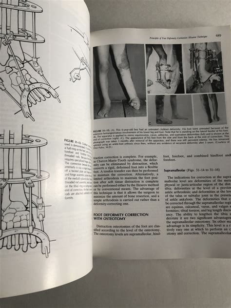 Operative Foot Surgery