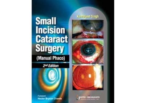 Small Incision Cataract Surgery: Manual Phaco