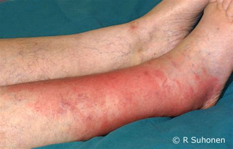 hudinfektioner bilder