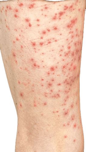 hudutslag efter pfizer