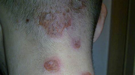 hudutslag vuxna bilder