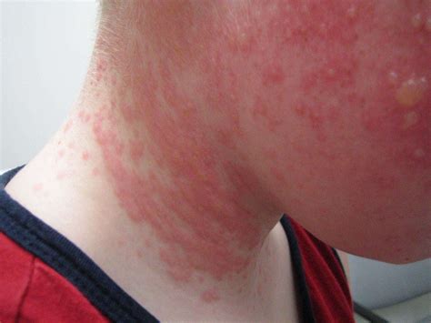 huidreacties symptomen