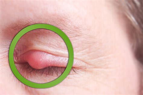 hur botar du ringningar