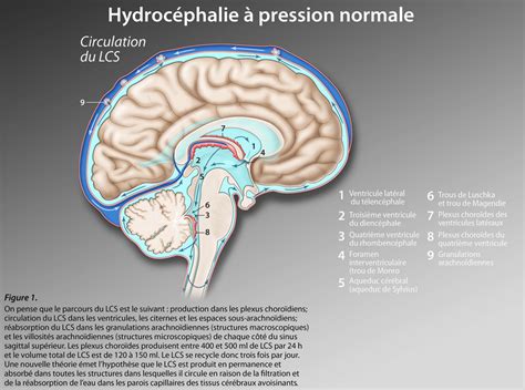 Hydrocéphalie Pression Normale