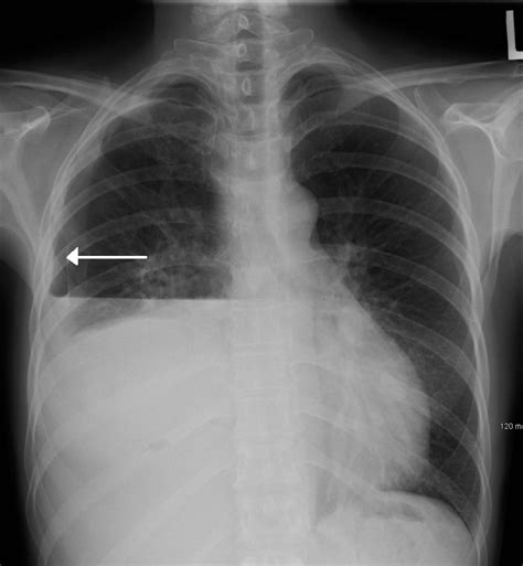 Hydropneumothorax X Ray