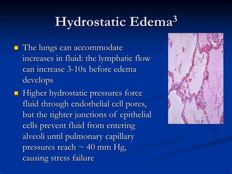 Hydrostatic Edema