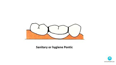 hygienic pontic