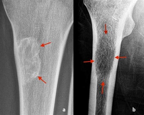 Hyperdense Lytic Bone Lesions