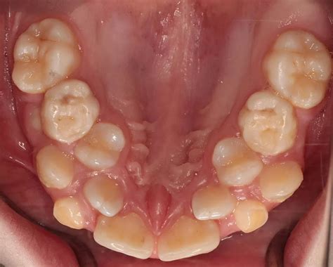 Hyperdontia Occurrence In Native American