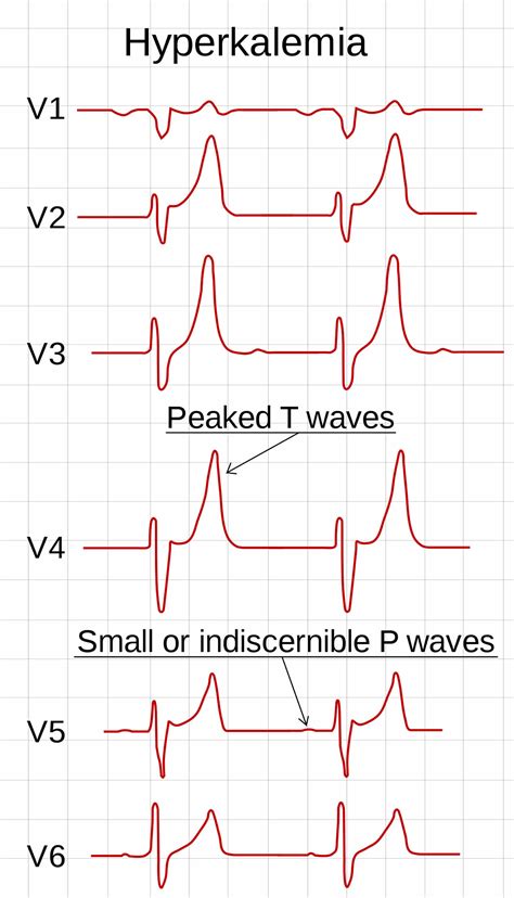 Hyperkalemia Ekg Changes