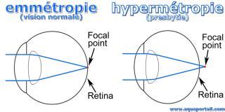hypermetropie