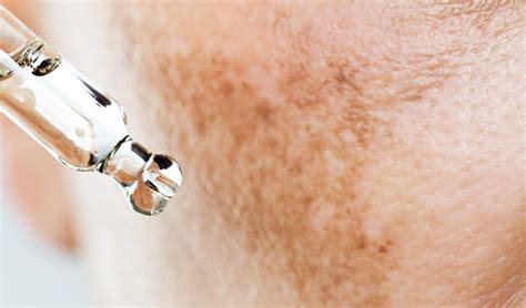 hyperpigmentering orsak