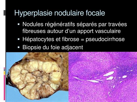 Hyperplasie Nodulaire Focale