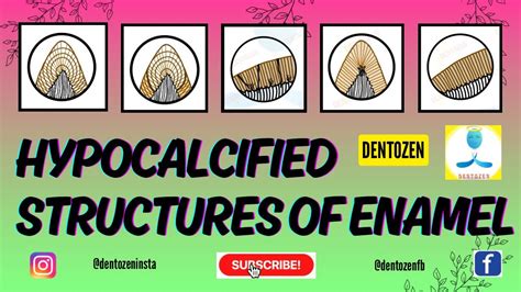 Hypocalcified Structures Of Enamel