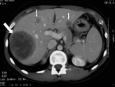 Hypodense Lesion Liver