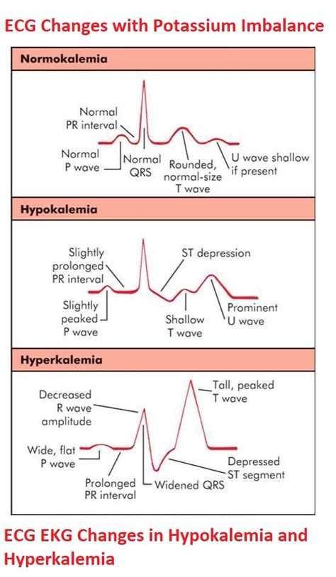 Hypokalemia Ecg Changes