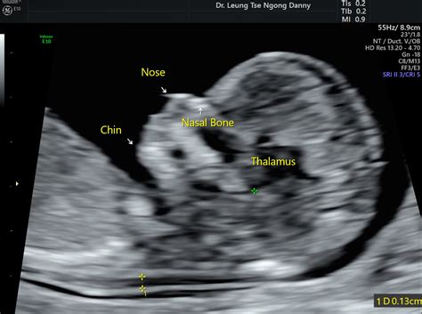 Hypoplastic Nasal Bone