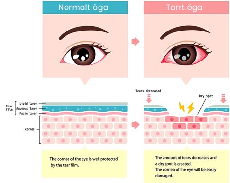 hypotyreos torra ögon